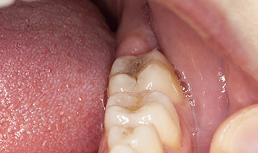 Periodontal Disease