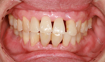 Periodontal Disease