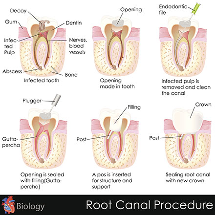 Restorations